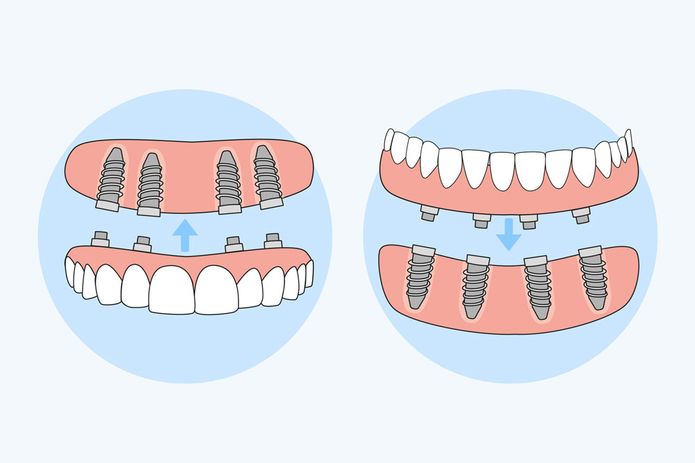 upload/alan2/dental/allonfour.jpg