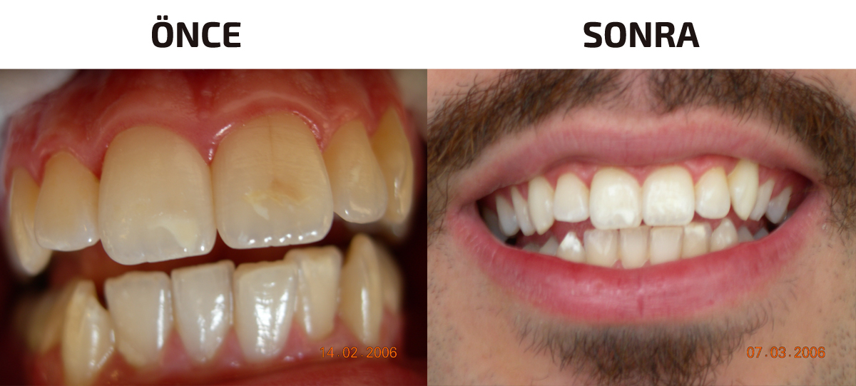 upload/alan2/dental/dis-beyazlatma-alimehmetbilik-2.jpg