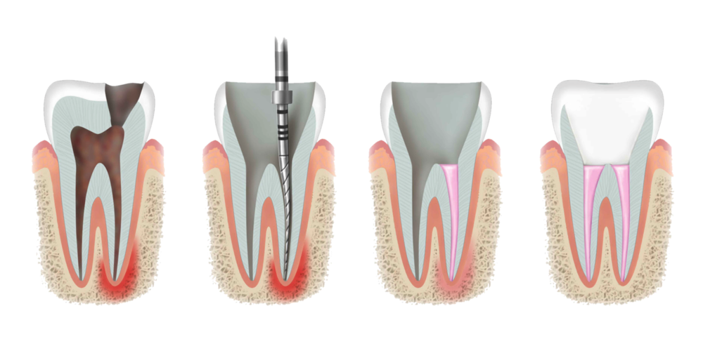 upload/alan2/dental/endodonti1.png