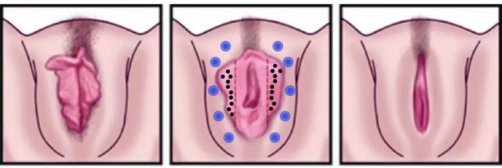 upload/alan2/estetik_cerrahi/genital/genital.png