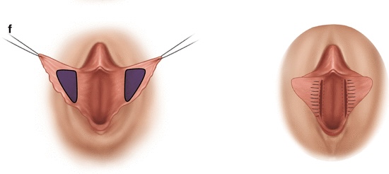upload/alan2/estetik_cerrahi/genital/labioplasti-ameliyati-nasil-yapilir.jpg