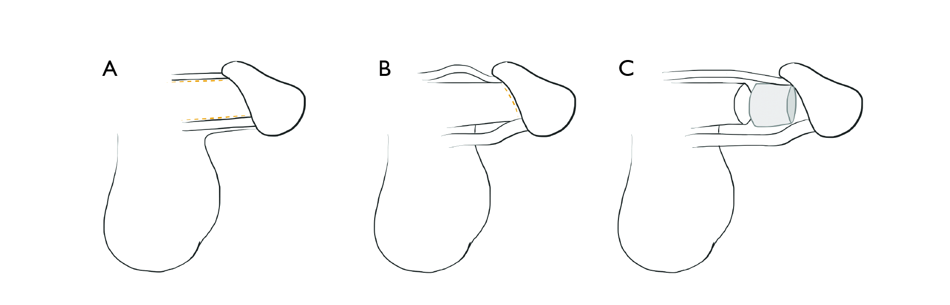 upload/alan2/estetik_cerrahi/genital/penis_uzatma.png