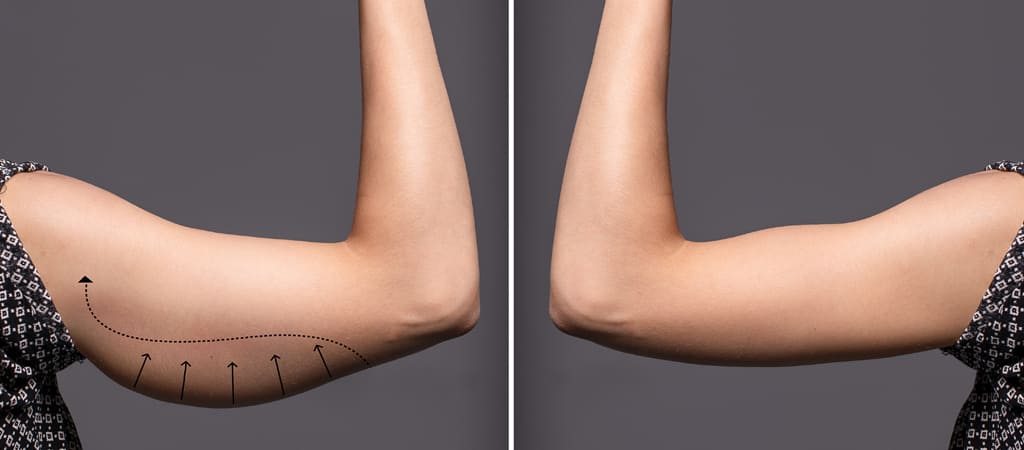 upload/alan2/estetik_cerrahi/vucut/brakioplasti-ve-thigh-lift-nedir.jpg