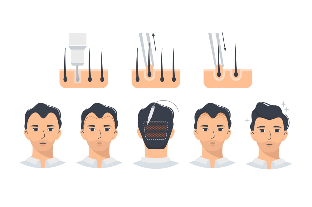 upload/alan2/sac_ekm/dhi_hair_transplant_medicalpark.jpg